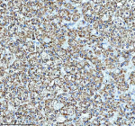 Immunohistochemical staining of GLUD1 using anti-GLUD1 antibody. GLUD1 was detected in a paraffin-embedded section of human adrenal adenoma tissue. Heat mediated antigen retrieval was performed in EDTA buffer (pH 8.0, epitope retrieval solution). The tissue section was blocked with 10% goat serum. The tissue section was then incubated with 2 ug/ml rabbit anti-GLUD1 antibody overnight at 4oC. Peroxidase Conjugated Goat Anti-rabbit IgG was used as secondary antibody and incubated for 30 minutes at 37oC. The tissue section was developed using an HRP secondary and DAB substrate.