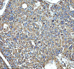 Immunohistochemical staining of GLUD1 using anti-GLUD1 antibody. GLUD1 was detected in a paraffin-embedded section of human liver cancer tissue. Heat mediated antigen retrieval was performed in EDTA buffer (pH 8.0, epitope retrieval solution). The tissue section was blocked with 10% goat serum. The tissue section was then incubated with 2 ug/ml rabbit anti-GLUD1 antibody overnight at 4oC. Peroxidase Conjugated Goat Anti-rabbit IgG was used as secondary antibody and incubated for 30 minutes at 37oC. The tissue section was developed using an HRP secondary and DAB substrate.