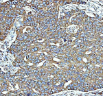 Immunohistochemical staining of GLUD1 using anti-GLUD1 antibody. GLUD1 was detected in a paraffin-embedded section of human ovarian cancer tissue. Heat mediated antigen retrieval was performed in EDTA buffer (pH 8.0, epitope retrieval solution). The tissue section was blocked with 10% goat serum. The tissue section was then incubated with 2 ug/ml rabbit anti-GLUD1 antibody overnight at 4oC. Peroxidase Conjugated Goat Anti-rabbit IgG was used as secondary antibody and incubated for 30 minutes at 37oC. The tissue section was developed using an HRP secondary and DAB substrate.