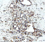 Immunohistochemical staining of GLUD1 using anti-GLUD1 antibody. GLUD1 was detected in a paraffin-embedded section of human stomach cancer tissue. Heat mediated antigen retrieval was performed in EDTA buffer (pH 8.0, epitope retrieval solution). The tissue section was blocked with 10% goat serum. The tissue section was then incubated with 2 ug/ml rabbit anti-GLUD1 antibody overnight at 4oC. Peroxidase Conjugated Goat Anti-rabbit IgG was used as secondary antibody and incubated for 30 minutes at 37oC. The tissue section was developed using an HRP secondary and DAB substrate.