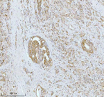 Immunohistochemical staining of SOAT1 using anti-SOAT1 antibody. SOAT1 was detected in a paraffin-embedded section of human prostatic cancer tissue. Heat mediated antigen retrieval was performed in EDTA buffer (pH 8.0, epitope retrieval solution). The tissue section was blocked with 10% goat serum. The tissue section was then incubated with 2 ug/ml rabbit anti-SOAT1 antibody overnight at 4oC. Peroxidase Conjugated Goat Anti-rabbit IgG was used as secondary antibody and incubated for 30 minutes at 37oC. The tissue section was developed using an HRP secondary and DAB substrate.