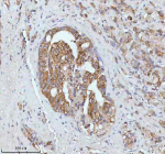 Immunohistochemical staining of SOAT1 using anti-SOAT1 antibody. SOAT1 was detected in a paraffin-embedded section of human prostatic cancer tissue. Heat mediated antigen retrieval was performed in EDTA buffer (pH 8.0, epitope retrieval solution). The tissue section was blocked with 10% goat serum. The tissue section was then incubated with 2 ug/ml rabbit anti-SOAT1 antibody overnight at 4oC. Peroxidase Conjugated Goat Anti-rabbit IgG was used as secondary antibody and incubated for 30 minutes at 37oC. The tissue section was developed using an HRP secondary and DAB substrate.