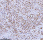 Immunohistochemical staining of SOAT1 using anti-SOAT1 antibody. SOAT1 was detected in a paraffin-embedded section of human prostatic cancer tissue. Heat mediated antigen retrieval was performed in EDTA buffer (pH 8.0, epitope retrieval solution). The tissue section was blocked with 10% goat serum. The tissue section was then incubated with 2 ug/ml rabbit anti-SOAT1 antibody overnight at 4oC. Peroxidase Conjugated Goat Anti-rabbit IgG was used as secondary antibody and incubated for 30 minutes at 37oC. The tissue section was developed using an HRP secondary and DAB substrate.