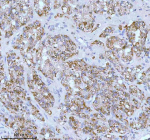 Immunohistochemical staining of SOAT1 using anti-SOAT1 antibody. SOAT1 was detected in a paraffin-embedded section of human prostatic cancer tissue. Heat mediated antigen retrieval was performed in EDTA buffer (pH 8.0, epitope retrieval solution). The tissue section was blocked with 10% goat serum. The tissue section was then incubated with 2 ug/ml rabbit anti-SOAT1 antibody overnight at 4oC. Peroxidase Conjugated Goat Anti-rabbit IgG was used as secondary antibody and incubated for 30 minutes at 37oC. The tissue section was developed using an HRP secondary and DAB substrate.