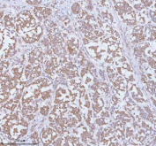 Immunohistochemical staining of SOAT1 using anti-SOAT1 antibody. SOAT1 was detected in a paraffin-embedded section of human breast cancer tissue. Heat mediated antigen retrieval was performed in EDTA buffer (pH 8.0, epitope retrieval solution). The tissue section was blocked with 10% goat serum. The tissue section was then incubated with 2 ug/ml rabbit anti-SOAT1 antibody overnight at 4oC. Peroxidase Conjugated Goat Anti-rabbit IgG was used as secondary antibody and incubated for 30 minutes at 37oC. The tissue section was developed using an HRP secondary and DAB substrate.