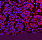 Immunofluorescent staining of FFPE human lung cancer tissue with RNF25 antibody (red) and DAPI nuclear stain (blue). HIER: steam section in pH8 EDTA buffer for 20 min.