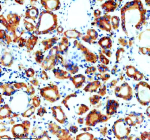 Immunohistochemical staining of SNX2 using anti-SNX2 antibody. SNX2 was detected in a paraffin-embedded section of human thyroid cancer tissue. Heat mediated antigen retrieval was performed in EDTA buffer (pH 8.0, epitope retrieval solution). The tissue section was blocked with 10% goat serum. The tissue section was then incubated with 2 ug/ml rabbit anti-SNX2 antibody overnight at 4oC. Peroxidase Conjugated Goat Anti-rabbit IgG was used as secondary antibody and incubated for 30 minutes at 37oC. The tissue section was developed using an HRP secondary and DAB substrate.