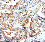 Immunohistochemical staining of SNX2 using anti-SNX2 antibody. SNX2 was detected in a paraffin-embedded section of human colon cancer tissue. Heat mediated antigen retrieval was performed in EDTA buffer (pH 8.0, epitope retrieval solution). The tissue section was blocked with 10% goat serum. The tissue section was then incubated with 2 ug/ml rabbit anti-SNX2 antibody overnight at 4oC. Peroxidase Conjugated Goat Anti-rabbit IgG was used as secondary antibody and incubated for 30 minutes at 37oC. The tissue section was developed using an HRP secondary and DAB substrate.