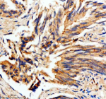 Immunohistochemical staining of MTMR3 using anti-MTMR3 antibody. MTMR3 was detected in a paraffin-embedded section of human prostate cancer tissue. Heat mediated antigen retrieval was performed in EDTA buffer (pH 8.0, epitope retrieval solution). The tissue section was blocked with 10% goat serum. The tissue section was then incubated with 2 ug/ml rabbit anti-MTMR3 antibody overnight at 4oC. Peroxidase Conjugated Goat Anti-rabbit IgG was used as secondary antibody and incubated for 30 minutes at 37oC. The tissue section was developed using an HRP secondary and DAB substrate.