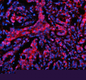 Immunofluorescent staining of MTMR3 using anti-MTMR3 antibody (red). MTMR3 was detected in a paraffin-embedded section of human breast cancer tissue. Heat mediated antigen retrieval was performed in EDTA buffer (pH 8.0, epitope retrieval solution). The tissue section was blocked with 10% goat serum. The tissue section was then incubated with 5 ug/ml rabbit anti-MTMR3 antibody overnight at 4oC. Cy3 Conjugated Goat Anti-Rabbit IgG was used as secondary antibody at 1:500 dilution and incubated for 30 minutes at 37oC. The section was counterstained with DAPI nuclear stain (blue). Visualize using a fluorescence microscope and filter sets appropriate for the label used.