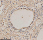 Immunohistochemical staining of MTMR3 using anti-MTMR3 antibody. MTMR3 was detected in a paraffin-embedded section of human prostate cancer tissue. Heat mediated antigen retrieval was performed in EDTA buffer (pH 8.0, epitope retrieval solution). The tissue section was blocked with 10% goat serum. The tissue section was then incubated with 2 ug/ml rabbit anti-MTMR3 antibody overnight at 4oC. Peroxidase Conjugated Goat Anti-rabbit IgG was used as secondary antibody and incubated for 30 minutes at 37oC. The tissue section was developed using an HRP secondary and DAB substrate.
