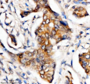 Immunohistochemical staining of MTMR3 using anti-MTMR3 antibody. MTMR3 was detected in a paraffin-embedded section of human breast cancer tissue. Heat mediated antigen retrieval was performed in EDTA buffer (pH 8.0, epitope retrieval solution). The tissue section was blocked with 10% goat serum. The tissue section was then incubated with 2 ug/ml rabbit anti-MTMR3 antibody overnight at 4oC. Peroxidase Conjugated Goat Anti-rabbit IgG was used as secondary antibody and incubated for 30 minutes at 37oC. The tissue section was developed using an HRP secondary and DAB substrate.
