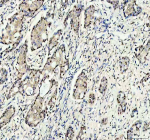 Immunohistochemical staining of RANBP3 using anti-RANBP3 antibody. RANBP3 was detected in a paraffin-embedded section of human breast cancer tissue. Heat mediated antigen retrieval was performed in EDTA buffer (pH 8.0, epitope retrieval solution). The tissue section was blocked with 10% goat serum. The tissue section was then incubated with 2 ug/ml rabbit anti-RANBP3 antibody overnight at 4oC. Peroxidase Conjugated Goat Anti-rabbit IgG was used as secondary antibody and incubated for 30 minutes at 37oC. The tissue section was developed using an HRP secondary and DAB substrate.