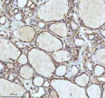 Immunohistochemical staining of IDH3B using anti-IDH3B antibody. IDH3B was detected in a paraffin-embedded section of follicles of human thyroid cancer tissue. Heat mediated antigen retrieval was performed in EDTA buffer (pH 8.0, epitope retrieval solution). The tissue section was blocked with 10% goat serum. The tissue section was then incubated with 2 ug/ml rabbit anti-IDH3B antibody overnight at 4oC. Peroxidase Conjugated Goat Anti-rabbit IgG was used as secondary antibody and incubated for 30 minutes at 37oC. The tissue section was developed using an HRP secondary and DAB substrate.