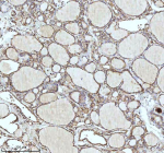 Immunohistochemical staining of IDH3B using anti-IDH3B antibody. IDH3B was detected in a paraffin-embedded section of follicles of human thyroid cancer tissue. Heat mediated antigen retrieval was performed in EDTA buffer (pH 8.0, epitope retrieval solution). The tissue section was blocked with 10% goat serum. The tissue section was then incubated with 2 ug/ml rabbit anti-IDH3B antibody overnight at 4oC. Peroxidase Conjugated Goat Anti-rabbit IgG was used as secondary antibody and incubated for 30 minutes at 37oC. The tissue section was developed using an HRP secondary and DAB substrate.