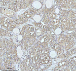 Immunohistochemical staining of IDH3B using anti-IDH3B antibody. IDH3B was detected in a paraffin-embedded section of follicles of human thyroid cancer tissue. Heat mediated antigen retrieval was performed in EDTA buffer (pH 8.0, epitope retrieval solution). The tissue section was blocked with 10% goat serum. The tissue section was then incubated with 2 ug/ml rabbit anti-IDH3B antibody overnight at 4oC. Peroxidase Conjugated Goat Anti-rabbit IgG was used as secondary antibody and incubated for 30 minutes at 37oC. The tissue section was developed using an HRP secondary and DAB substrate.