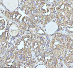 Immunohistochemical staining of IDH3B using anti-IDH3B antibody. IDH3B was detected in a paraffin-embedded section of follicles of human thyroid cancer tissue. Heat mediated antigen retrieval was performed in EDTA buffer (pH 8.0, epitope retrieval solution). The tissue section was blocked with 10% goat serum. The tissue section was then incubated with 2 ug/ml rabbit anti-IDH3B antibody overnight at 4oC. Peroxidase Conjugated Goat Anti-rabbit IgG was used as secondary antibody and incubated for 30 minutes at 37oC. The tissue section was developed using an HRP secondary and DAB substrate.