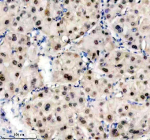 Immunohistochemical staining of TRIM47 using anti-TRIM47 antibody. TRIM47 was detected in a paraffin-embedded section of human liver cancer tissue. Heat mediated antigen retrieval was performed in EDTA buffer (pH 8.0, epitope retrieval solution). The tissue section was blocked with 10% goat serum. The tissue section was then incubated with 2 ug/ml rabbit anti-TRIM47 antibody overnight at 4oC. Peroxidase Conjugated Goat Anti-rabbit IgG was used as secondary antibody and incubated for 30 minutes at 37oC. The tissue section was developed using an HRP secondary and DAB substrate.