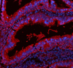 Immunofluorescent staining of ADAM12 using anti-ADAM12 antibody (red). ADAM12 was detected in a paraffin-embedded section of human endometrial cancer tissue. Heat mediated antigen retrieval was performed in EDTA buffer (pH 8.0, epitope retrieval solution). The tissue section was blocked with 10% goat serum. The tissue section was then incubated with 5 ug/ml rabbit anti-ADAM12 antibody overnight at 4oC. Cy3 Conjugated Goat Anti-Rabbit IgG was used as secondary antibody at 1:500 dilution and incubated for 30 minutes at 37oC. The section was counterstained with DAPI nuclear stain (blue). Visualize using a fluorescence microscope and filter sets appropriate for the label used.