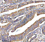 Immunohistochemical staining of NOXO1 using anti-NOXO1 antibody. NOXO1 was detected in a paraffin-embedded section of human colon cancer tissue. Heat mediated antigen retrieval was performed in EDTA buffer (pH 8.0, epitope retrieval solution). The tissue section was blocked with 10% goat serum. The tissue section was then incubated with 2 ug/ml rabbit anti-NOXO1 antibody overnight at 4oC. Peroxidase Conjugated Goat Anti-rabbit IgG was used as secondary antibody and incubated for 30 minutes at 37oC. The tissue section was developed using an HRP secondary and DAB substrate.