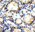 Immunohistochemical staining of REST using anti-REST antibody. REST was detected in a paraffin-embedded section of human thyroid cancer tissue. Heat mediated antigen retrieval was performed in EDTA buffer (pH 8.0, epitope retrieval solution). The tissue section was blocked with 10% goat serum. The tissue section was then incubated with 2 ug/ml rabbit anti-REST antibody overnight at 4oC. Peroxidase Conjugated Goat Anti-rabbit IgG was used as secondary antibody and incubated for 30 minutes at 37oC. The tissue section was developed using an HRP secondary and DAB substrate.