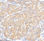 Immunohistochemical staining of IQGAP2 using anti-IQGAP2 antibody. IQGAP2 was detected in a paraffin-embedded section of human liver cancer tissue. Heat mediated antigen retrieval was performed in EDTA buffer (pH 8.0, epitope retrieval solution). The tissue section was blocked with 10% goat serum. The tissue section was then incubated with 1:50 rabbit anti-IQGAP2 antibody overnight at 4oC. Peroxidase Conjugated Goat Anti-rabbit IgG was used as secondary antibody and incubated for 30 minutes at 37oC. The tissue section was developed using an HRP secondary and DAB substrate.