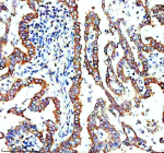 Immunohistochemical staining of TMEM173/STING using anti-STING1 antibody. TMEM173/STING was detected in a paraffin-embedded section of human lung cancer tissue. Heat mediated antigen retrieval was performed in EDTA buffer (pH 8.0, epitope retrieval solution). The tissue section was blocked with 10% goat serum. The tissue section was then incubated with 2 ug/ml rabbit anti-STING1 antibody overnight at 4oC. Peroxidase Conjugated Goat Anti-rabbit IgG was used as secondary antibody and incubated for 30 minutes at 37oC. The tissue section was developed using an HRP secondary and DAB substrate.