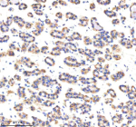 Immunohistochemical staining of MTCH2 using anti-MTCH2 antibody. MTCH2 was detected in a paraffin-embedded section of human thyroid cancer tissue. Heat mediated antigen retrieval was performed in EDTA buffer (pH 8.0, epitope retrieval solution). The tissue section was blocked with 10% goat serum. The tissue section was then incubated with 2 ug/ml rabbit anti-MTCH2 antibody overnight at 4oC. Peroxidase Conjugated Goat Anti-rabbit IgG was used as secondary antibody and incubated for 30 minutes at 37oC. The tissue section was developed using an HRP secondary and DAB substrate.
