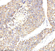 Immunohistochemical staining of MTCH2 using anti-MTCH2 antibody. MTCH2 was detected in a paraffin-embedded section of human liver cancer tissue. Heat mediated antigen retrieval was performed in EDTA buffer (pH 8.0, epitope retrieval solution). The tissue section was blocked with 10% goat serum. The tissue section was then incubated with 2 ug/ml rabbit anti-MTCH2 antibody overnight at 4oC. Peroxidase Conjugated Goat Anti-rabbit IgG was used as secondary antibody and incubated for 30 minutes at 37oC. The tissue section was developed using an HRP secondary and DAB substrate.
