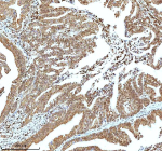 Immunohistochemical staining of Histone H3 using anti-Histone H3 antibody. Histone H3 was detected in a paraffin-embedded section of human colon adenocarcinoma tissue. Heat mediated antigen retrieval was performed in EDTA buffer (pH 8.0, epitope retrieval solution). The tissue section was blocked with 10% goat serum. The tissue section was then incubated with 2 ug/ml rabbit anti-Histone H3 antibody overnight at 4oC. Peroxidase Conjugated Goat Anti-rabbit IgG was used as secondary antibody and incubated for 30 minutes at 37oC. The tissue section was developed using an HRP secondary and DAB substrate.