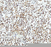 Immunohistochemical staining of Histone H3 using anti-Histone H3 antibody. Histone H3 was detected in a paraffin-embedded section of human testicular seminoma tissue. Heat mediated antigen retrieval was performed in EDTA buffer (pH 8.0, epitope retrieval solution). The tissue section was blocked with 10% goat serum. The tissue section was then incubated with 2 ug/ml rabbit anti-Histone H3 antibody overnight at 4oC. Peroxidase Conjugated Goat Anti-rabbit IgG was used as secondary antibody and incubated for 30 minutes at 37oC. The tissue section was developed using an HRP secondary and DAB substrate.