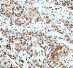 Immunohistochemical staining of Histone H3 using anti-Histone H3 antibody. Histone H3 was detected in a paraffin-embedded section of human esophageal squamous carcinoma tissue. Heat mediated antigen retrieval was performed in EDTA buffer (pH 8.0, epitope retrieval solution). The tissue section was blocked with 10% goat serum. The tissue section was then incubated with 2 ug/ml rabbit anti-Histone H3 antibody overnight at 4oC. Peroxidase Conjugated Goat Anti-rabbit IgG was used as secondary antibody and incubated for 30 minutes at 37oC. The tissue section was developed using an HRP secondary and DAB substrate.