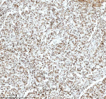 Immunohistochemical staining of Histone H3 using anti-Histone H3 antibody. Histone H3 was detected in a paraffin-embedded section of human lung cancer tissue. Heat mediated antigen retrieval was performed in EDTA buffer (pH 8.0, epitope retrieval solution). The tissue section was blocked with 10% goat serum. The tissue section was then incubated with 2 ug/ml rabbit anti-Histone H3 antibody overnight at 4oC. Peroxidase Conjugated Goat Anti-rabbit IgG was used as secondary antibody and incubated for 30 minutes at 37oC. The tissue section was developed using an HRP secondary and DAB substrate.