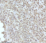 Immunohistochemical staining of PIPOX using anti-PIPOX antibody. PIPOX was detected in a paraffin-embedded section of human ovary cancer tissue. Heat mediated antigen retrieval was performed in EDTA buffer (pH 8.0, epitope retrieval solution). The tissue section was blocked with 10% goat serum. The tissue section was then incubated with 2 ug/ml rabbit anti-PIPOX antibody overnight at 4oC. Peroxidase Conjugated Goat Anti-rabbit IgG was used as secondary antibody and incubated for 30 minutes at 37oC. The tissue section was developed using an HRP secondary and DAB substrate.