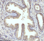 Immunohistochemical staining of PIPOX using anti-PIPOX antibody. PIPOX was detected in a paraffin-embedded section of human prostate cancer tissue. Heat mediated antigen retrieval was performed in EDTA buffer (pH 8.0, epitope retrieval solution). The tissue section was blocked with 10% goat serum. The tissue section was then incubated with 2 ug/ml rabbit anti-PIPOX antibody overnight at 4oC. Peroxidase Conjugated Goat Anti-rabbit IgG was used as secondary antibody and incubated for 30 minutes at 37oC. The tissue section was developed using an HRP secondary and DAB substrate.