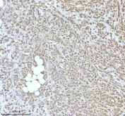 Immunohistochemical staining of PIPOX using anti-PIPOX antibody. PIPOX was detected in a paraffin-embedded section of human ovary cancer tissue. Heat mediated antigen retrieval was performed in EDTA buffer (pH 8.0, epitope retrieval solution). The tissue section was blocked with 10% goat serum. The tissue section was then incubated with 2 ug/ml rabbit anti-PIPOX antibody overnight at 4oC. Peroxidase Conjugated Goat Anti-rabbit IgG was used as secondary antibody and incubated for 30 minutes at 37oC. The tissue section was developed using an HRP secondary and DAB substrate.