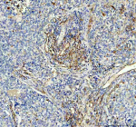 Immunohistochemical staining of ACE using anti-ACE antibody. ACE was detected in a paraffin-embedded section of human lung cancer tissue. Heat mediated antigen retrieval was performed in EDTA buffer (pH 8.0, epitope retrieval solution). The tissue section was blocked with 10% goat serum. The tissue section was then incubated with 2 ug/ml rabbit anti-ACE antibody overnight at 4oC. Peroxidase Conjugated Goat Anti-rabbit IgG was used as secondary antibody and incubated for 30 minutes at 37oC. The tissue section was developed using an HRP secondary and DAB substrate.