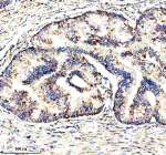 Immunohistochemical staining of MSTO1 using anti-MSTO1 antibody. MSTO1 was detected in a paraffin-embedded section of human prostate cancer tissue. Heat mediated antigen retrieval was performed in EDTA buffer (pH 8.0, epitope retrieval solution). The tissue section was blocked with 10% goat serum. The tissue section was then incubated with 2 ug/ml rabbit anti-MSTO1 antibody overnight at 4oC. Peroxidase Conjugated Goat Anti-rabbit IgG was used as secondary antibody and incubated for 30 minutes at 37oC. The tissue section was developed using an HRP secondary and DAB substrate.