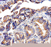 Immunohistochemical staining of GEF-H1/ARHGEF2 using anti-ARHGEF2 antibody. GEF-H1/ARHGEF2 was detected in a paraffin-embedded section of human colon cancer tissue. Heat mediated antigen retrieval was performed in EDTA buffer (pH 8.0, epitope retrieval solution). The tissue section was blocked with 10% goat serum. The tissue section was then incubated with 2 ug/ml rabbit anti-ARHGEF2 antibody overnight at 4oC. Peroxidase Conjugated Goat Anti-rabbit IgG was used as secondary antibody and incubated for 30 minutes at 37oC. The tissue section was developed using an HRP secondary and DAB substrate.