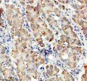 Immunohistochemical staining of TDO2 using anti-TDO2 antibody. TDO2 was detected in a paraffin-embedded section of human liver cancer tissue. Heat mediated antigen retrieval was performed in EDTA buffer (pH 8.0, epitope retrieval solution). The tissue section was blocked with 10% goat serum. The tissue section was then incubated with 2 ug/ml rabbit anti-TDO2 antibody overnight at 4oC. Peroxidase Conjugated Goat Anti-rabbit IgG was used as secondary antibody and incubated for 30 minutes at 37oC. The tissue section was developed using an HRP secondary and DAB substrate.