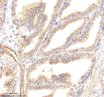 Immunohistochemical staining of GBF1 using anti-GBF1 antibody. GBF1 was detected in a paraffin-embedded section of human prostate cancer tissue. Heat mediated antigen retrieval was performed in EDTA buffer (pH 8.0, epitope retrieval solution). The tissue section was blocked with 10% goat serum. The tissue section was then incubated with 2 ug/ml rabbit anti-GBF1 antibody overnight at 4oC. Peroxidase Conjugated Goat Anti-rabbit IgG was used as secondary antibody and incubated for 30 minutes at 37oC. The tissue section was developed using an HRP secondary and DAB substrate.