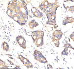 Immunohistochemical staining of GBF1 using anti-GBF1 antibody. GBF1 was detected in a paraffin-embedded section of human breast cancer tissue. Heat mediated antigen retrieval was performed in EDTA buffer (pH 8.0, epitope retrieval solution). The tissue section was blocked with 10% goat serum. The tissue section was then incubated with 2 ug/ml rabbit anti-GBF1 antibody overnight at 4oC. Peroxidase Conjugated Goat Anti-rabbit IgG was used as secondary antibody and incubated for 30 minutes at 37oC. The tissue section was developed using an HRP secondary and DAB substrate.