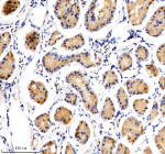 Immunohistochemical staining of NUSAP1 using anti-NUSAP1 antibody. NUSAP1 was detected in a paraffin-embedded section of human stomach cancer tissue. Heat mediated antigen retrieval was performed in EDTA buffer (pH 8.0, epitope retrieval solution). The tissue section was blocked with 10% goat serum. The tissue section was then incubated with 1:100 rabbit anti-NUSAP1 antibody overnight at 4oC. Peroxidase Conjugated Goat Anti-rabbit IgG was used as secondary antibody and incubated for 30 minutes at 37oC. The tissue section was developed using an HRP secondary and DAB substrate.