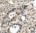 Immunohistochemical staining of NUSAP1 using anti-NUSAP1 antibody. NUSAP1 was detected in a paraffin-embedded section of human stomach cancer tissue. Heat mediated antigen retrieval was performed in EDTA buffer (pH 8.0, epitope retrieval solution). The tissue section was blocked with 10% goat serum. The tissue section was then incubated with 2 ug/ml rabbit anti-NUSAP1 antibody overnight at 4oC. Peroxidase Conjugated Goat Anti-rabbit IgG was used as secondary antibody and incubated for 30 minutes at 37oC. The tissue section was developed using an HRP secondary and DAB substrate.