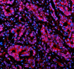 Immunofluorescent staining of NUSAP1 using anti-NUSAP1 antibody (red). NUSAP1 was detected in a paraffin-embedded section of human stomach cancer tissue. Heat mediated antigen retrieval was performed in EDTA buffer (pH 8.0, epitope retrieval solution). The tissue section was blocked with 10% goat serum. The tissue section was then incubated with 5 ug/ml rabbit anti-NUSAP1 antibody overnight at 4oC. Cy3 Conjugated Goat Anti-Rabbit IgG was used as secondary antibody at 1:500 dilution and incubated for 30 minutes at 37oC. The section was counterstained with DAPI nuclear stain (blue). Visualize using a fluorescence microscope and filter sets appropriate for the label used.