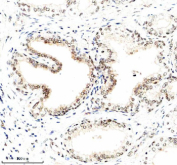 Immunohistochemical staining of NUSAP1 using anti-NUSAP1 antibody. NUSAP1 was detected in a paraffin-embedded section of human prostate cancer tissue. Heat mediated antigen retrieval was performed in EDTA buffer (pH 8.0, epitope retrieval solution). The tissue section was blocked with 10% goat serum. The tissue section was then incubated with 1:100 rabbit anti-NUSAP1 antibody overnight at 4oC. Peroxidase Conjugated Goat Anti-rabbit IgG was used as secondary antibody and incubated for 30 minutes at 37oC. The tissue section was developed using an HRP secondary and DAB substrate.