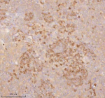 Immunohistochemical staining of SSSCA1/ZNRD2 using anti-ZNRD2 antibody. SSSCA1/ZNRD2 was detected in a paraffin-embedded section of human cervix squamous cell carcinoma tissue. Heat mediated antigen retrieval was performed in EDTA buffer (pH 8.0, epitope retrieval solution). The tissue section was blocked with 10% goat serum. The tissue section was then incubated with 2 ug/ml rabbit anti-ZNRD2 antibody overnight at 4oC. Peroxidase Conjugated Goat Anti-rabbit IgG was used as secondary antibody and incubated for 30 minutes at 37oC. The tissue section was developed using an HRP secondary and DAB substrate.