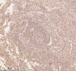 Immunohistochemical staining of SSSCA1/ZNRD2 using anti-ZNRD2 antibody. SSSCA1/ZNRD2 was detected in a paraffin-embedded section of human lung squamous cell carcinoma tissue. Heat mediated antigen retrieval was performed in EDTA buffer (pH 8.0, epitope retrieval solution). The tissue section was blocked with 10% goat serum. The tissue section was then incubated with 2 ug/ml rabbit anti-ZNRD2 antibody overnight at 4oC. Peroxidase Conjugated Goat Anti-rabbit IgG was used as secondary antibody and incubated for 30 minutes at 37oC. The tissue section was developed using an HRP secondary and DAB substrate.