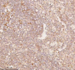 Immunohistochemical staining of SSSCA1/ZNRD2 using anti-ZNRD2 antibody. SSSCA1/ZNRD2 was detected in a paraffin-embedded section of human lung squamous cell carcinoma tissue. Heat mediated antigen retrieval was performed in EDTA buffer (pH 8.0, epitope retrieval solution). The tissue section was blocked with 10% goat serum. The tissue section was then incubated with 2 ug/ml rabbit anti-ZNRD2 antibody overnight at 4oC. Peroxidase Conjugated Goat Anti-rabbit IgG was used as secondary antibody and incubated for 30 minutes at 37oC. The tissue section was developed using an HRP secondary and DAB substrate.