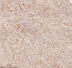 Immunohistochemical staining of SSSCA1/ZNRD2 using anti-ZNRD2 antibody. SSSCA1/ZNRD2 was detected in a paraffin-embedded section of human rectum adenocarcinoma tissue. Heat mediated antigen retrieval was performed in EDTA buffer (pH 8.0, epitope retrieval solution). The tissue section was blocked with 10% goat serum. The tissue section was then incubated with 2 ug/ml rabbit anti-ZNRD2 antibody overnight at 4oC. Peroxidase Conjugated Goat Anti-rabbit IgG was used as secondary antibody and incubated for 30 minutes at 37oC. The tissue section was developed using an HRP secondary and DAB substrate.